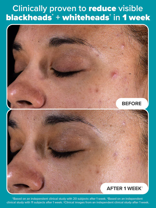 Paula’s Choice Exfoliator 118 ML